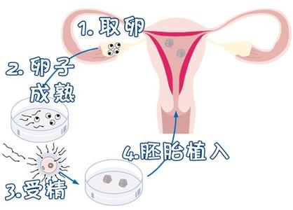 高龄二胎案例